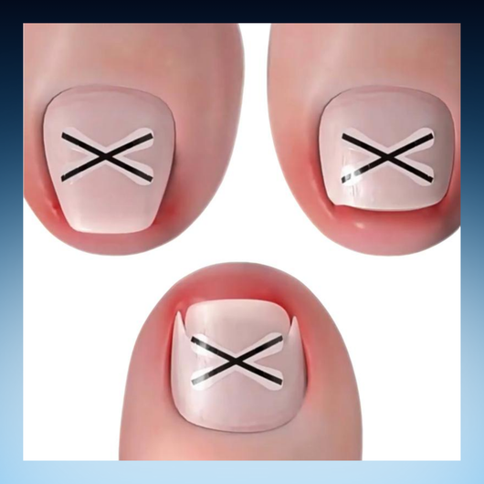 Ingrown Toenail Correction Strips