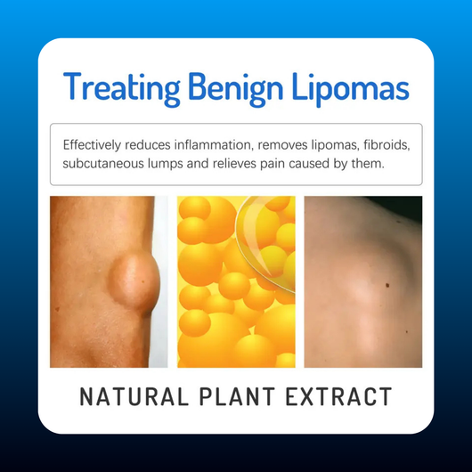 Lipoma Relieving Lump Cream
