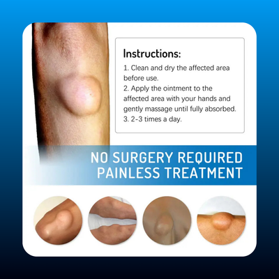 Lipoma Relieving Lump Cream