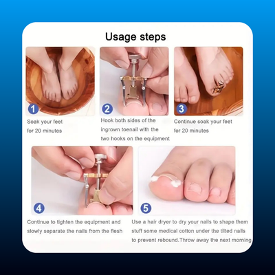 Ingrown Toenail Lifter Tool
