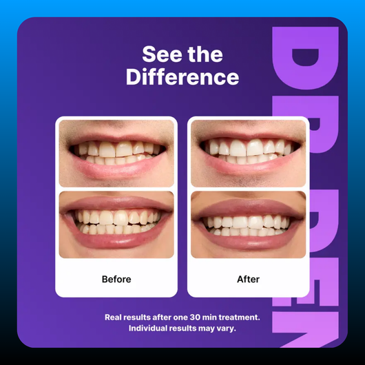 Purple Teeth Whitening Strips