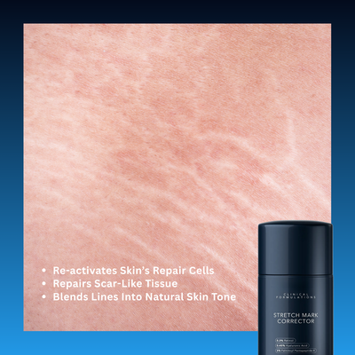 Stretch Mark Corrector