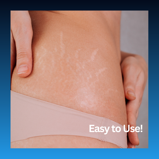 Stretch Mark Corrector