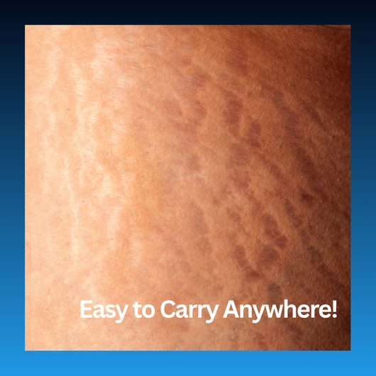 Stretch Mark Corrector