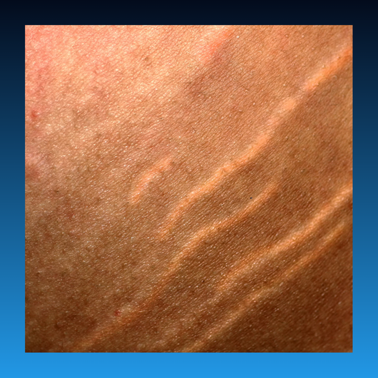 Stretch Mark Corrector