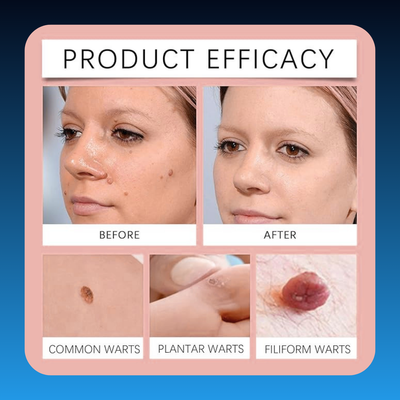 Powerful Wart Eliminator Cream