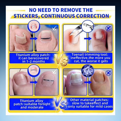 Ingrown Toenail Correction Strips