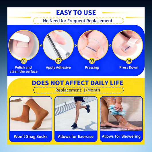 Ingrown Toenail Correction Strips